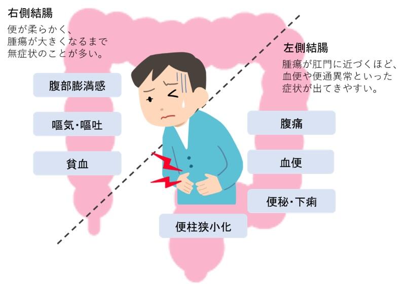 大腸がんの症状