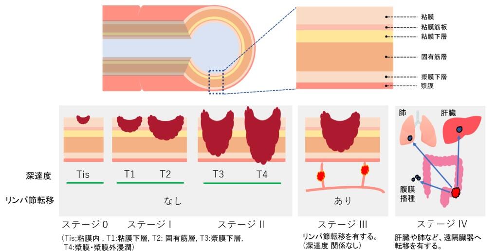 大腸がんの進行度分類（ステージ）