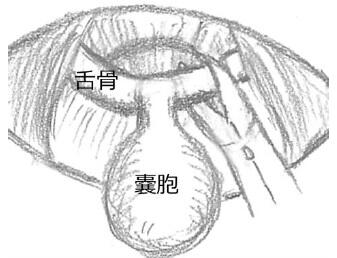 20250128_舌骨中央部