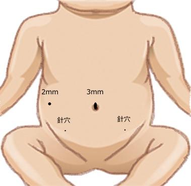 腹腔鏡下鼠径ヘルニア根治術_1.jpg