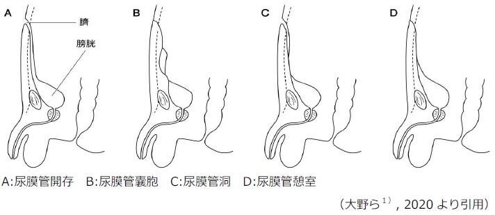図1尿膜管遺残症の病型