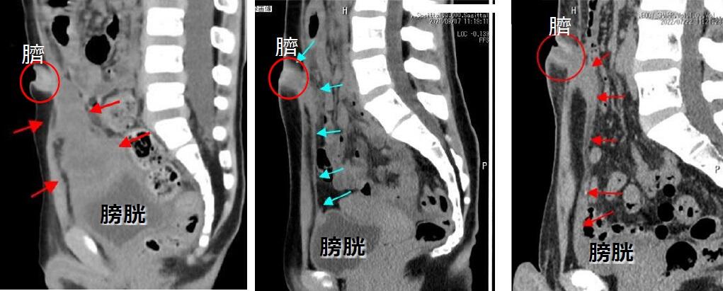 図3 腹部CT検査でお臍から膀胱につながる病変を確認します.jpg