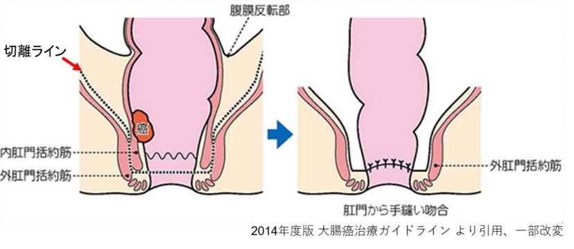 肛門温存のこだわり