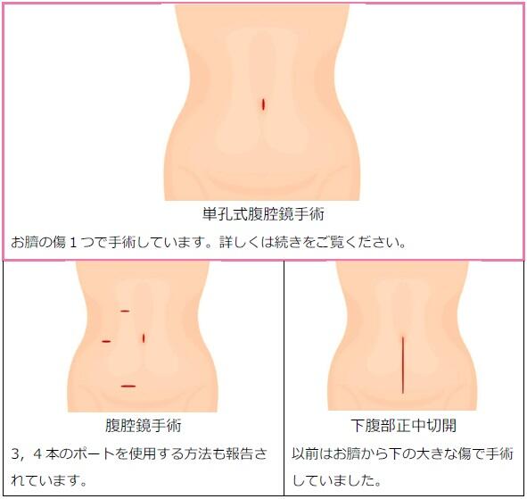図3 当科はお臍の傷だけで手術をします