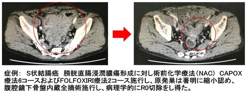 高度進行がんへの術前化学放射線療法を含む集学的治療